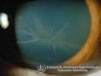 Bilateral corneal verticillata in a patient who is treated chronically with amiodarone.